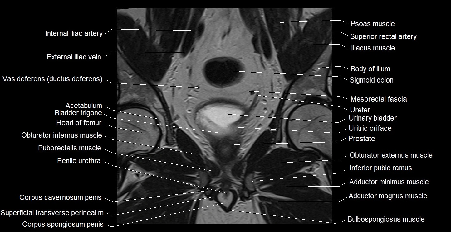 MRI coronal cross sectional anatomy male pelvis image 19.webp